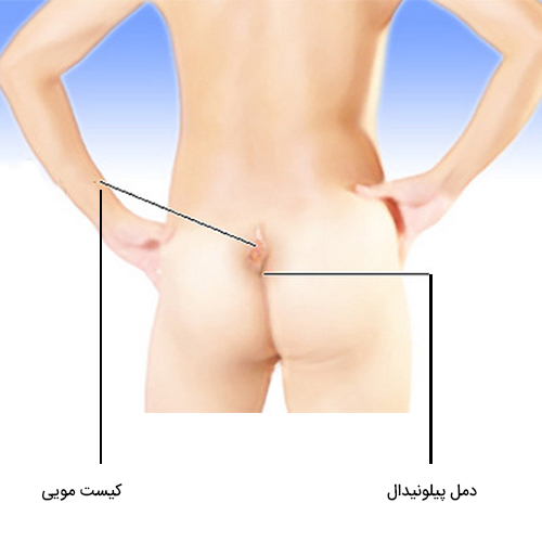 درمان کیست مویی یا سینوس پیلونیدال با لیزر، بدون درد و خونریزی و عدم نیاز به بستری در 1 جلسه