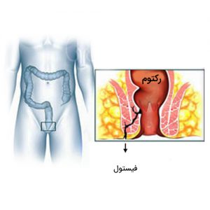 عکس شکل فیستول مقعدی