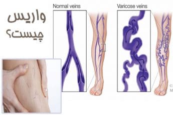 واریس چیست؟ چه علائمی دارد و چگونه درمان میشود؟