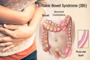 سندرم روده تحریک پذیر چیست؟ علائم و علل بروز این بیماری؟