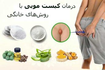 بهترین روشهای درمان خانگی کیست مویی یا سینوس پیلونیدال