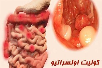کولیت اولسراتیو چیست و چه علائمی دارد؟