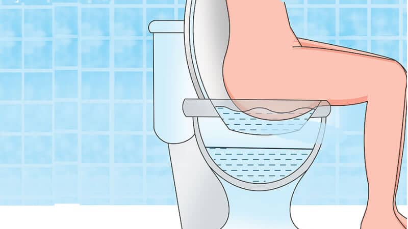 حمام sitz درمان گر بیماری‌های بواسیر (هموروئید)، شقاق، کیست مویی، فیستول