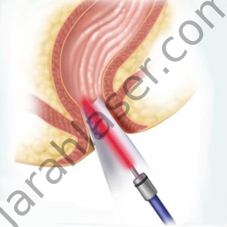 hemorrhoid-treatment-with-laser-450x450.jpg