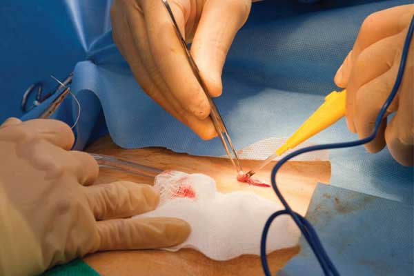 عمل جراحی کیست مویی دنبالچه سرپایی⚡روشهای باز و بسته - کلینیک مهنا