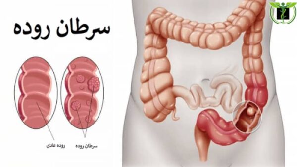 توده های سرطانی در روده