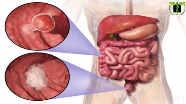 کانسر روده بزرگ