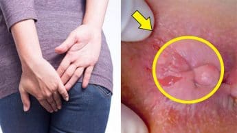 بایدها و نبایدهایی برای پیشگیری از هموروئید یا بواسیر