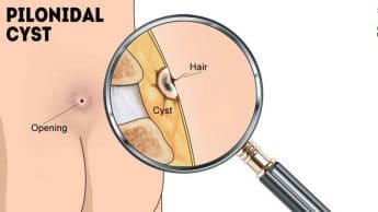 چگونه از ایجاد کیست مویی پیشگیری کنیم؟