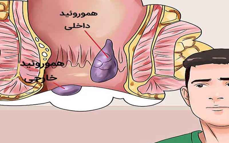 درمان قطعی بواسیر یا هموروئید با لیزر بدون درد و خونریزی و بدون بازگشت