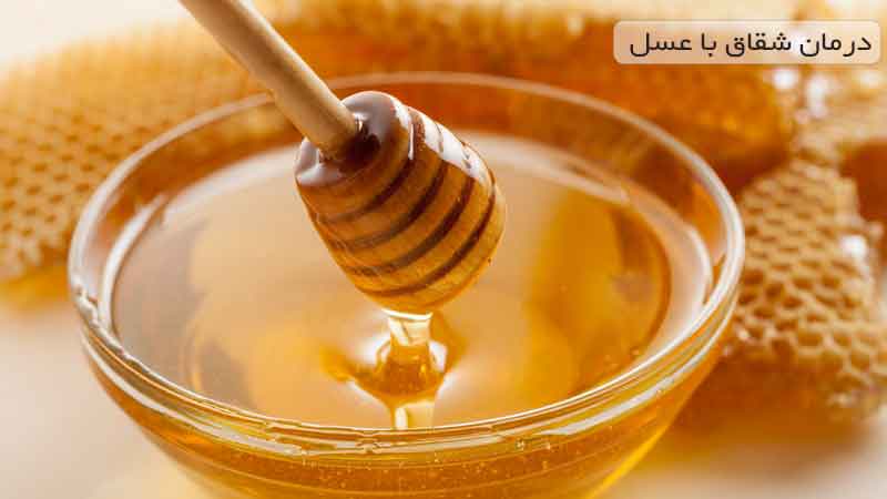 نحوه درمان شقاق با عسل به روش سنتی