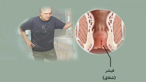 بیماری شقاق یا فیشر مقعدی