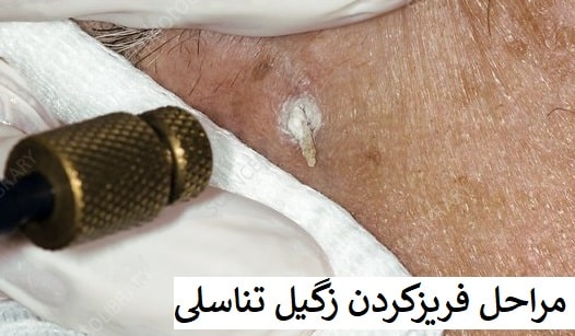 مراحل انجام کرایوسرجری در کلینیک مهنا