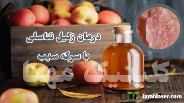 درمان زگیل تناسلی با سرکه سیب
