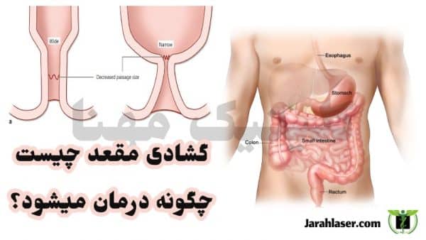 گشادی مقعد چیست