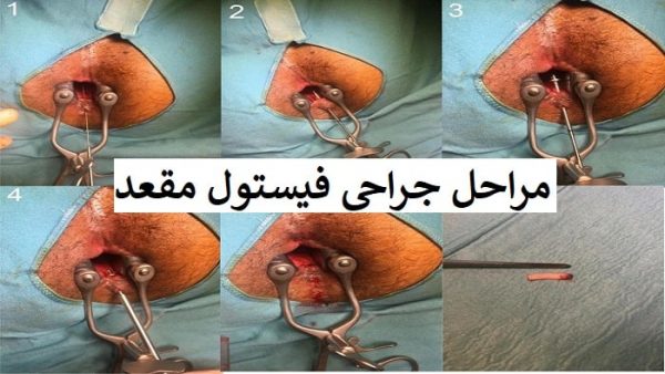 عوارض عمل جراحی فیستول مقعد در مقایسه با لیزر