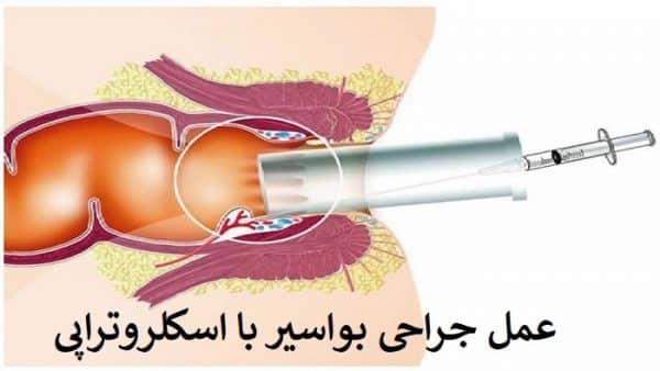 Hemorrhoid operation with sclerotherapy
