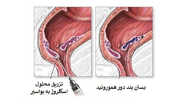 آمپول بواسیر و تزریق اسکلروز