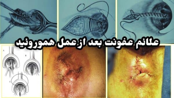 علائم عفونت بعد از عمل هموروئید