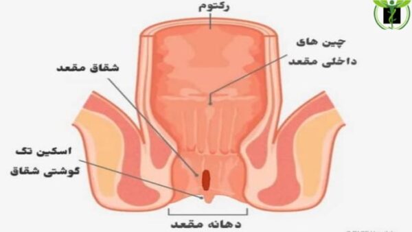 عکس بیماری شقاق مقعدی