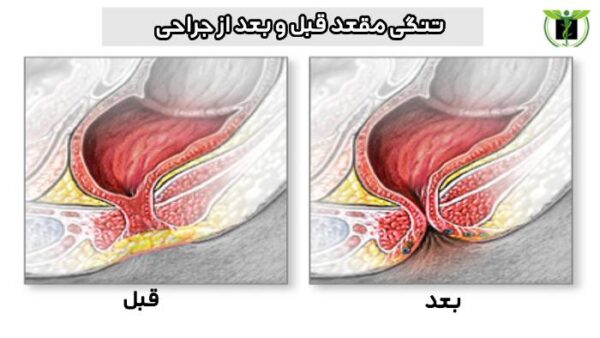 تنگی مقعد قبل و بعد از جراحی