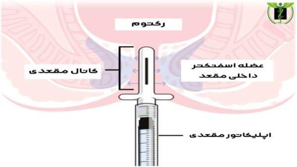 تصویری از نحوه استفاده از اپلیکاتور مقعدی 