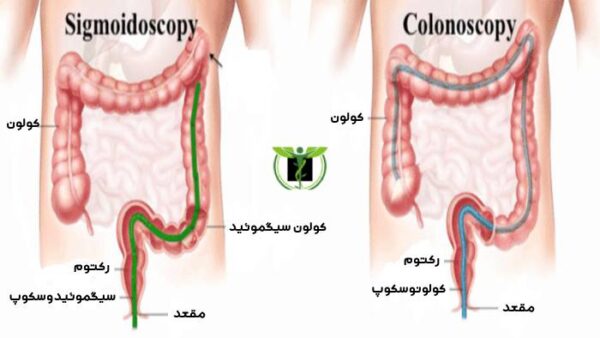 تفاوت سیگموئیدوسکوپی و کولونوسکوپی