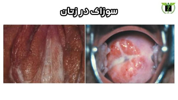 تصویری از سوزاک در زنان 