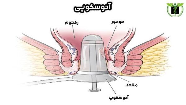 آنوسکوپی چیست