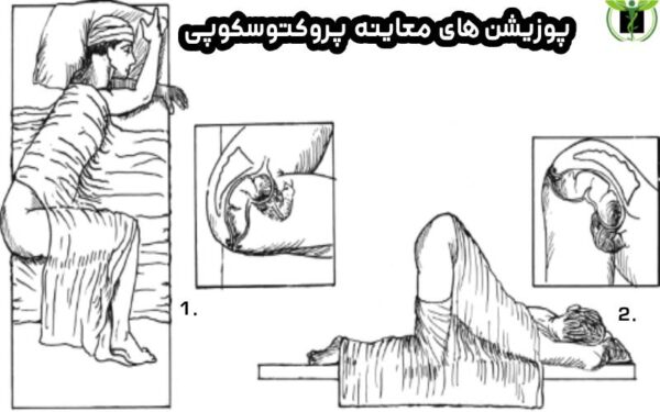 پوزیشن های معاینه پروکتوسکوپی