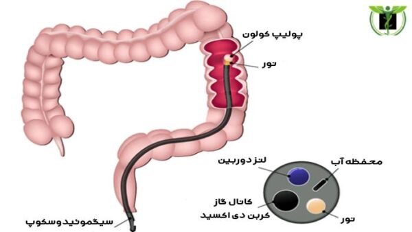 تصویری از سیگموئیدوسکوپ
