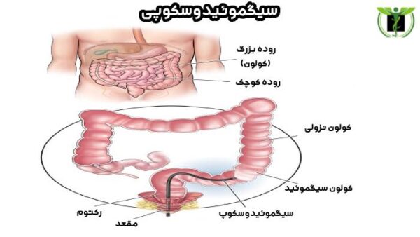 فرایند آزمایش سیگموئیدوسکوپی 