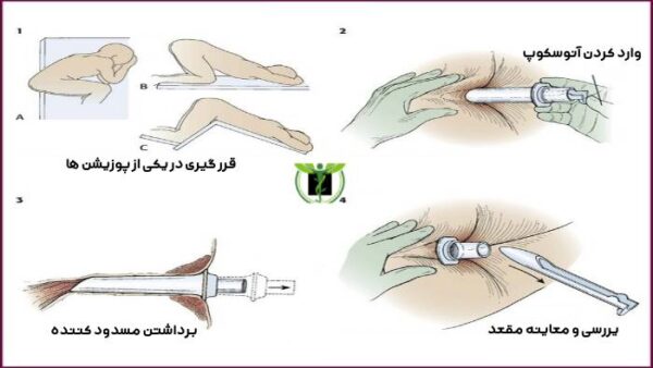 فرایند معاینه آنوسکوپی