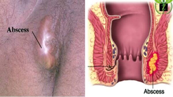 آبسه مقعدی یکی از دلایل ایجاد ورم مقعد
