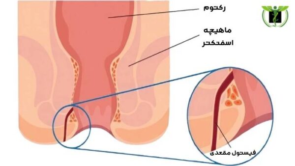 فیستول مقعدی از عوامل موثر در اجابت مزاج