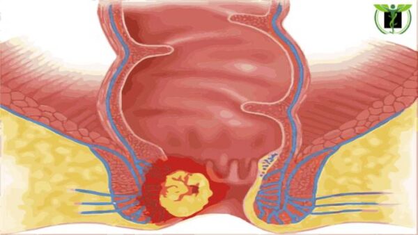 یکی از ذلایل ترشحات مقعدی سرطان مقعد