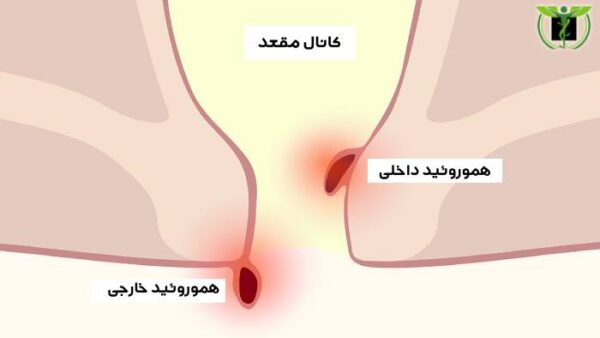 تصویری از هموروئید داخلی و هموروئید خارجی دلیل ترشحات مقعدی